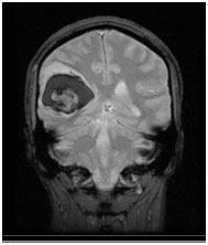 Melanoma with bleeding